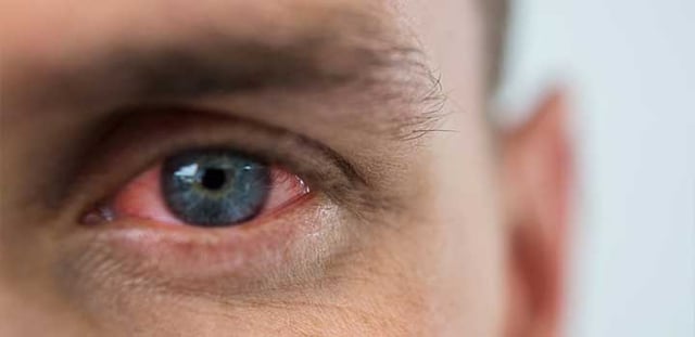 queratitis-ocular