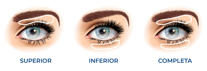 tipos-blefaroplastia