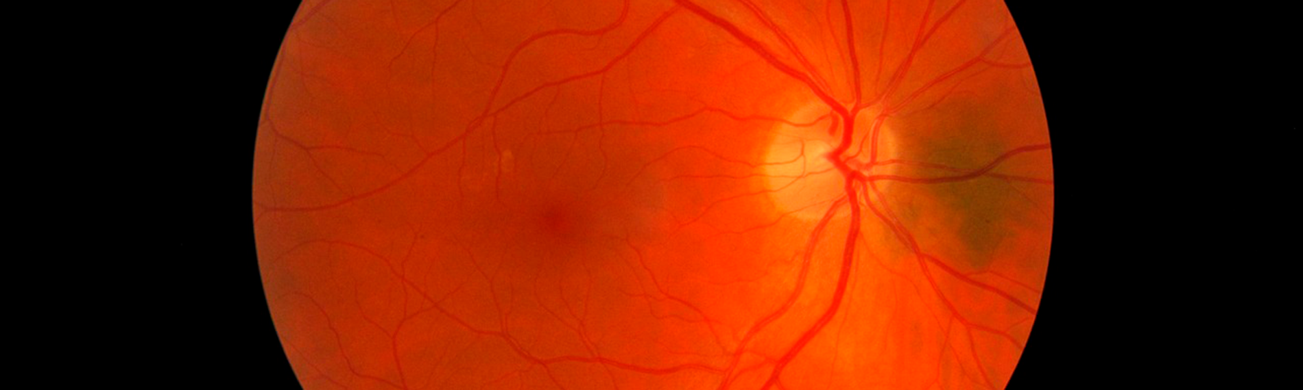 desprendimiento de retina por traumatismo